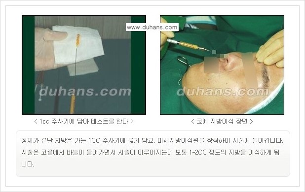 [두한성형외과 경쟁력 미세지방이식] - [자연스러운 코높임 지방이식 안내 ①] 관련 이미지 8