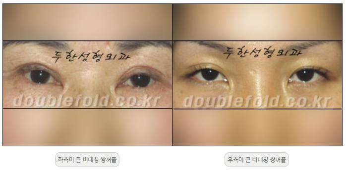 [두한성형외과 쌍커플재수술] - [비대칭 쌍커풀 라인] 관련 이미지 2