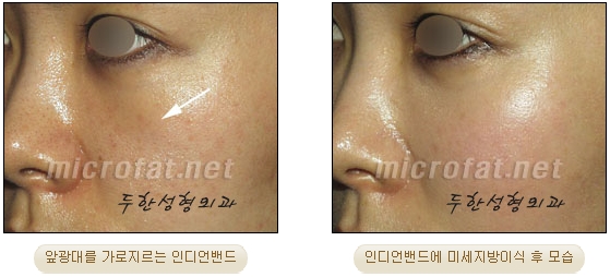 [Duhan Plastic Surgery Face Autologous Fat Grafting] - [Noble Surgery and Indian Band Fat Grafting] image 22