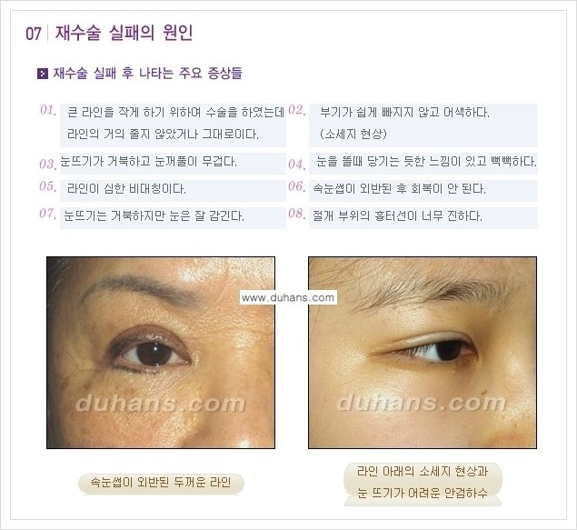 ​​[두한성형외과 경쟁력 쌍꺼풀(눈) 재수술] - [쌍꺼풀(눈) 재수술 실패의 원인 분석 안내] 관련 이미지 2