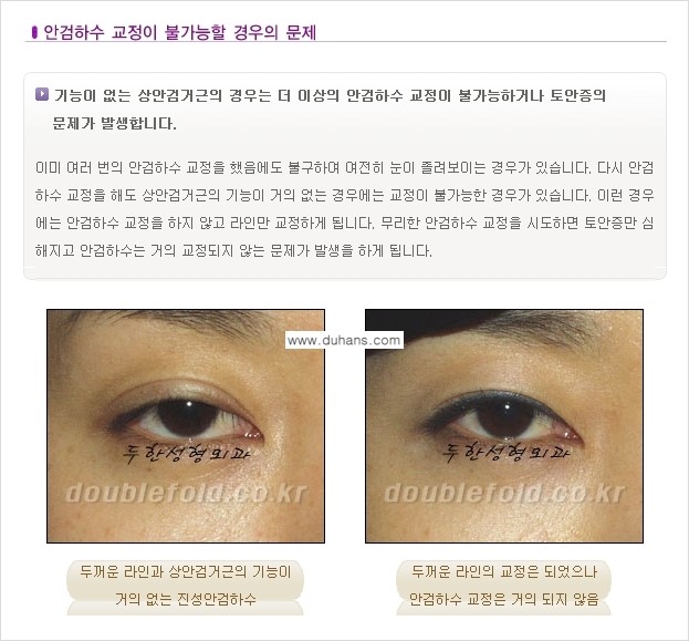 [두한성형외과 극한 재수술, 쌍꺼풀 재수술] - [쌍꺼풀 재수술에서 극복해야 할 극한의 상황과 문제] 관련 이미지 9