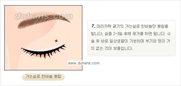 [두한성형외과 경쟁력 지방제거, 지방재배치] - [상큼하고 젊은 눈매 만들기 안내] 관련 이미지 9