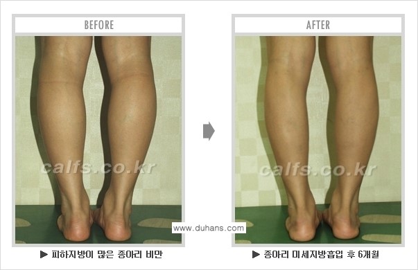 [두한성형외과 매력적인 종아리 만들기!] - [정교한 미세흡입관 지방흡입술 3.] 관련 이미지 12