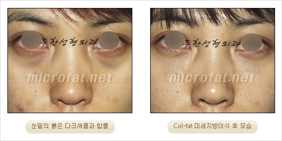 [두한성형외과 경쟁력 눈밑성형] - [Dr. 컬럼 - 눈밑 다크써클의 치료 방법과 치료 효과] 관련 이미지 5