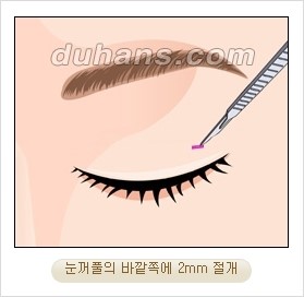 ⁠⁠[두한성형외과 경쟁력 안검성형] - [젊은 눈매를 위한 윗눈꺼풀 지방제거, 눈밑 지방제거] 관련 이미지 5