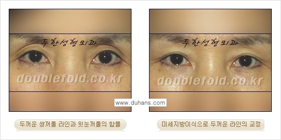 [두한성형외과 경쟁력 눈성형] - [미세지방이식으로 두꺼운 쌍꺼풀 라인의 교정 방법 안내] 관련 이미지 15