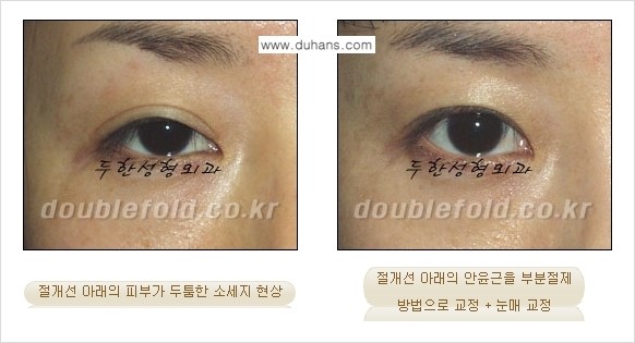 [두한성형외과 경쟁력 극한눈(쌍꺼풀)재수술] - [절개선 아래가 두툼한 소세지 쌍꺼풀 교정] 관련 이미지 6