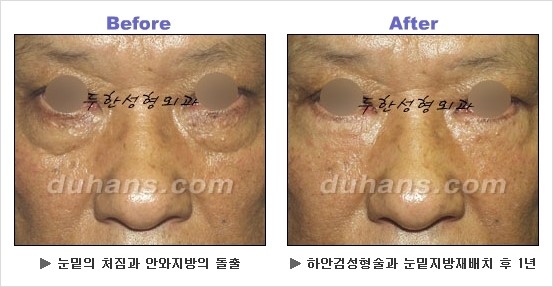 [두한성형외과 경쟁력 동안성형 리더] - ​[미간주름, 이마주름, 안검성형, 이마거상술, 눈썹거상술] 관련 이미지 84