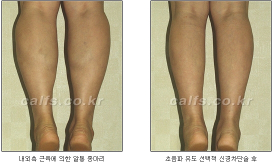 [두한성형외과 종아리퇴축술] - [NO절개! 초음파유도신경차단술] 관련 이미지 36