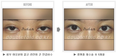 두한성형외과 쌍커풀 재수술 - 짝눈 눈매교정, 가성 안검하수 교정과 뒤밑트임 관련 이미지 34