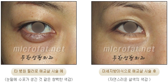 [두한성형외과 지방이식] - [다크서클, 눈밑주름] 관련 이미지 96