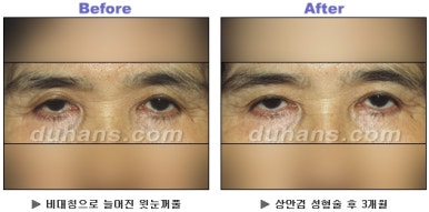 Blepharoplasty, Duhan Plastic Surgery - Upper and Lower Eyelids image 14