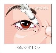 [두한성형외과 경쟁력 눈성형] - [흉터없는 몽고주름 제거술(앞트임) 관련 이미지 7