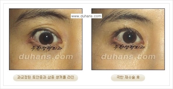 [두한성형외과 경쟁력 망가진 눈 복원수술] - [두꺼운 라인을 교정하는 극한 재수술(Extreme Reoperation) 안내] 관련 이미지 4