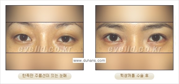 [두한성형외과 성형 FOCUS] - [퀵쌍꺼풀 수술 ④] 관련 이미지 6