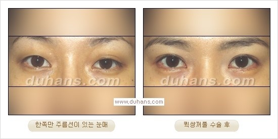 ​[두한성형외과 경쟁력 눈성형] - [자연스럽고 아름다운 쌍꺼풀의 기준] 관련 이미지 21