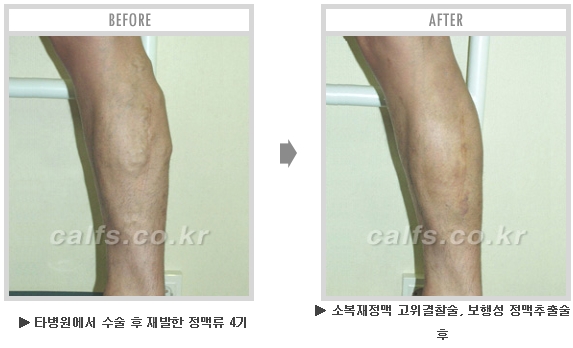 [종아리성형 두한성형외과] - [종아리수술에 대한 자주하는 질문과 답변 모음] 관련 이미지 22