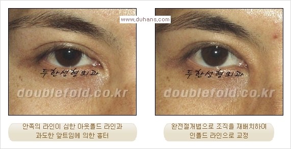 [두한성형외과 경쟁력 눈성형] - [두꺼운 아웃폴드 라인을 인폴드 라인으로 교정] 관련 이미지 9