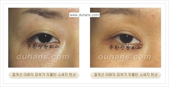 [두한성형외과 경쟁력 쌍꺼풀 재수술(극한 재수술)] - [절개선 아래가 두툼한 소세지 현상 안내] 관련 이미지 1