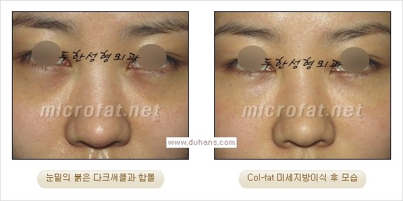 [두한성형외과 경쟁력 눈밑성형] - [눈밑이 전반적으로 함몰된 다크써클 교정 안내] 관련 이미지 5