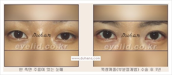 [두한성형외과 경쟁력 눈성형, 쌍꺼풀 수술] - [퀵쌍꺼풀(부분절개법)의 수술 안내] 관련 이미지 14