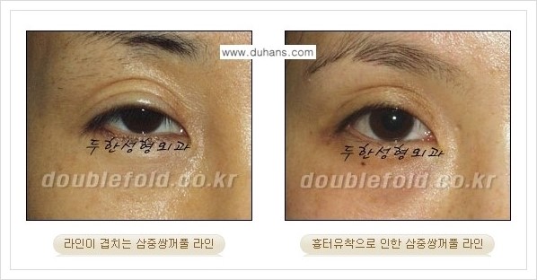 [두한성형외과 경쟁력 쌍꺼풀 재수술] - [삼중 쌍꺼풀 라인의 교정 안내] 관련 이미지 1