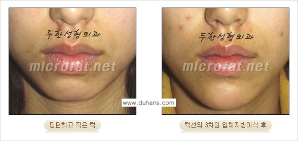 [두한성형외과 경쟁력 미세지방이식] - [얼굴 윤곽 무턱교정 안내 ②] 관련 이미지 8