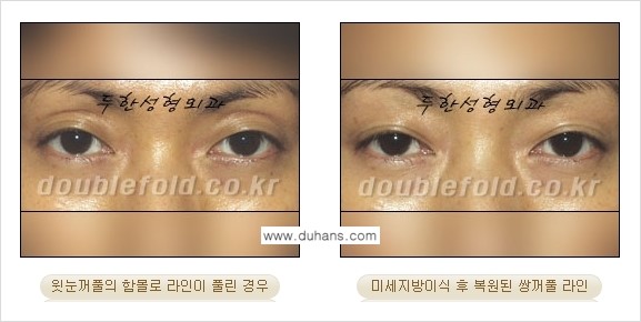 [두한성형외과 NO.1 눈성형] - [함몰된(꺼진) 눈꺼풀에서 쌍꺼풀 라인 교정 3.] 관련 이미지 10
