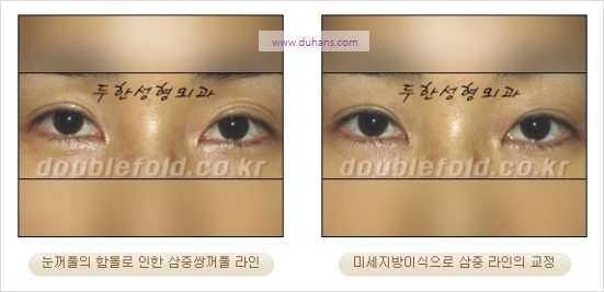 [두한성형외과 경쟁력 눈성형] - [쌍꺼풀 재수술 과정과 쌍꺼풀 재수술 실패의 원인, 쌍꺼풀 재수술의 성공 요건] 관련 이미지 58