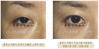 Best Place for Revision Eyelid Surgery, Duhan Plastic Surgery - Lowering Double Eyelid Line image 25