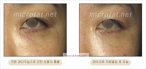 [두한성형외과 경쟁력 지방이식] - [두한 자가지방이식 클리닉 안내]​ 관련 이미지 86