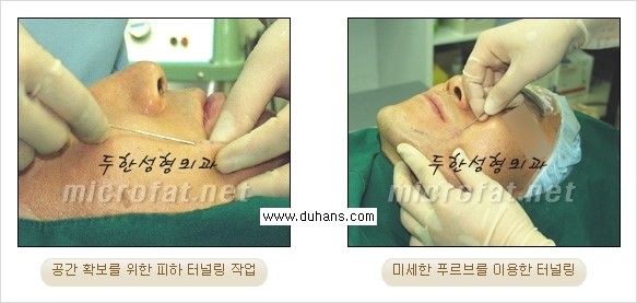 [두한성형외과 경쟁력 미세지방이식] - [Dr. 컬럼 "미세지방이식 클리닉의 특징과 자부심"] 관련 이미지 5