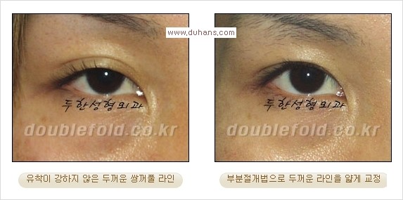 [두한성형외과 경쟁력 눈성형] - [부분절개법(Partial incision method)의 재수술 과정] 관련 이미지 11