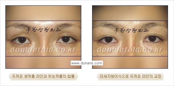 [두한성형외과 경쟁력 눈성형] - [미세지방이식으로 두꺼운 쌍꺼풀 라인의 교정 방법 안내] 관련 이미지 7