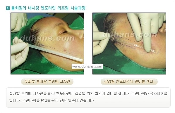 [두한성형외과 젊어지는 주름교정술] - [주름제거 시술방법 ②] 관련 이미지 8