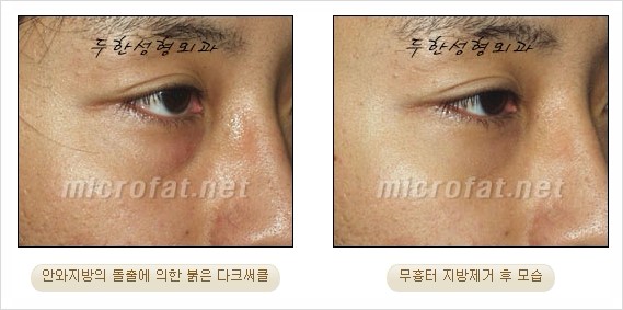 [두한성형외과 쌍커풀수술] - [눈성형 방법에 대한 자주하는 질문과 답변] 관련 이미지 195
