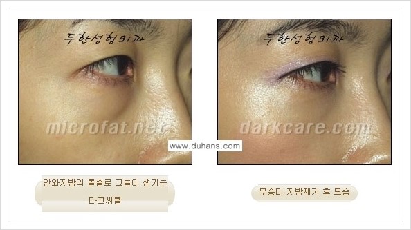 [두한성형외과 경쟁력 눈밑성형] - [눈밑지방제거, 눈위지방제거 안내 1.] 관련 이미지 24