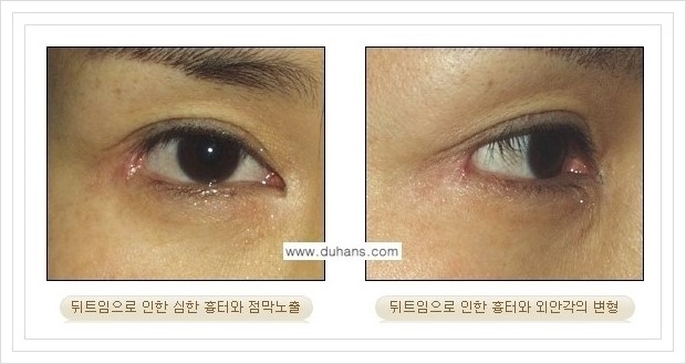 [두한성형외과 경쟁력 쌍꺼풀 재수술, 극한 눈재수술] - [뒤트임 부작용과 뒤트임 교정수술 방법 안내] 관련 이미지 11