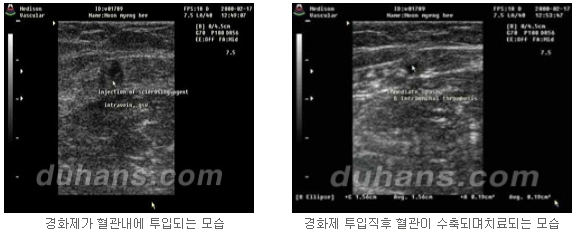 [두한성형외과 정맥류] - [하지정맥류, 정맥확장증, 혈관확장증] 관련 이미지 12