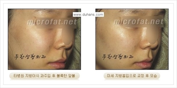 [두한성형외과 경쟁력 볼살지방이식] - [타병원 지방이식 후 - 굴곡이 발생한 경우, 과주입으로 인해 볼살이 불룩한 경우 안내] 관련 이미지 9