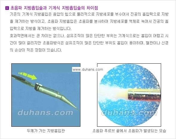 [두한성형외과 경쟁력 간편지방흡입] - [복부(뱃살) 비만 간편지방흡입] 관련 이미지 6
