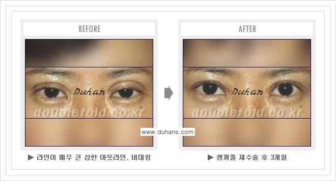 [두한성형외과 경쟁력 쌍꺼풀 재수술, 극한 재수술] - [여러번의 재수술로 인해 흉살이 두터운 경우 교정 방법 안내] 관련 이미지 5