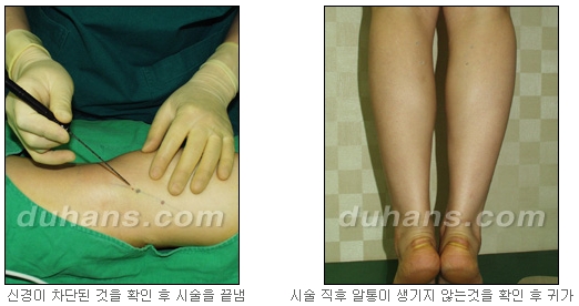 [두한성형외과 종아리축소술] - [초음파 유도 선택적 신경차단술 안내] 관련 이미지 15