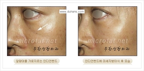 [두한성형외과 경쟁력 미세지방이식] - [귀족수술과 인디언밴드 교정 안내] 관련 이미지 16