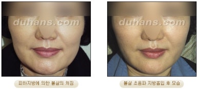 [두한성형외과 안전한 지방흡입] - [얼굴지방흡입] 관련 이미지 21