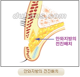 눈성형잘하는곳 두한성형외과 - 겹쌍꺼풀 관련 이미지 18
