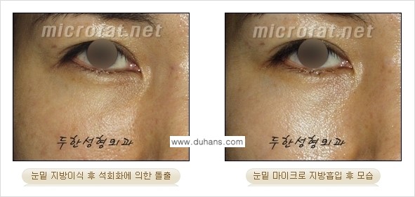 [두한성형외과 경쟁력 미세지방흡입] - [안면부의 안전한 미세지방흡입 안내] 관련 이미지 13