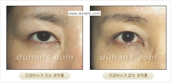 ​[두한성형외과 경쟁력 눈성형] - [매력적이고 아름다운 쌍꺼풀 라인과 쌍꺼풀 재수술 대상과 교정 방법] 관련 이미지 1