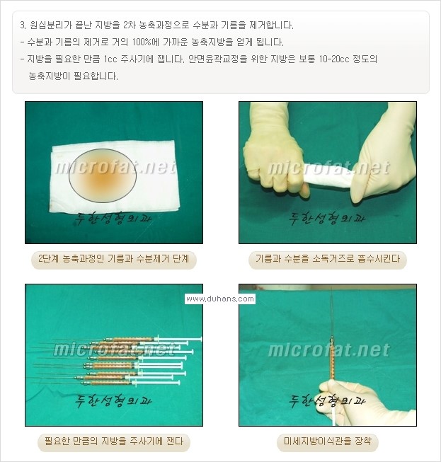 [두한성형외과 경쟁력 미세지방이식] - [타 병원에서 볼살 지방이식 이후 부작용 교정 방법 안내] 관련 이미지 21