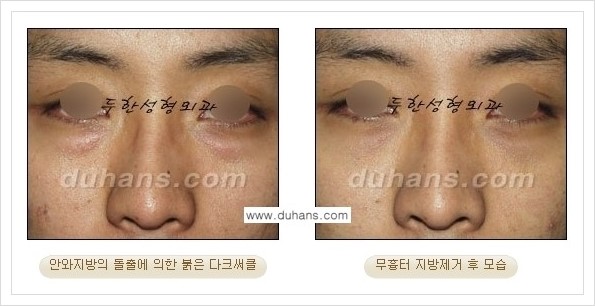 [두한성형외과 경쟁력 안검성형] - [눈밑 지방제거 안내] 관련 이미지 20